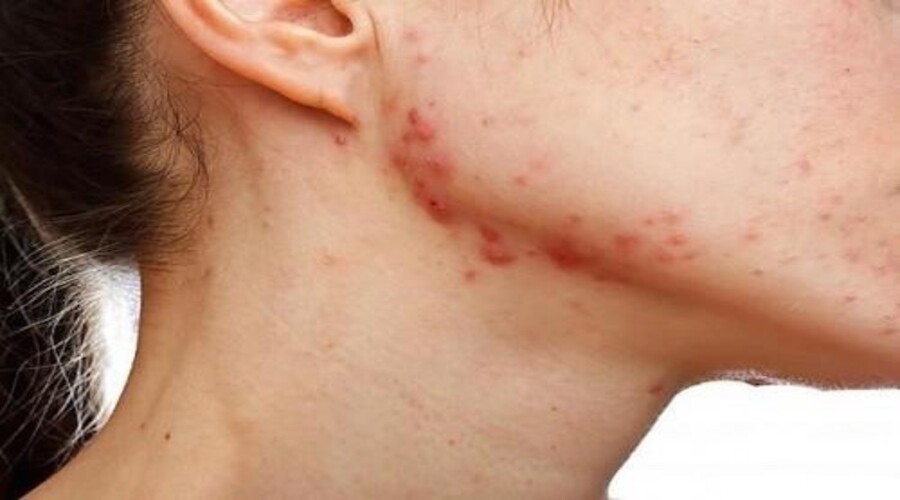 Comment éliminer les traces d'acné naturellement ?