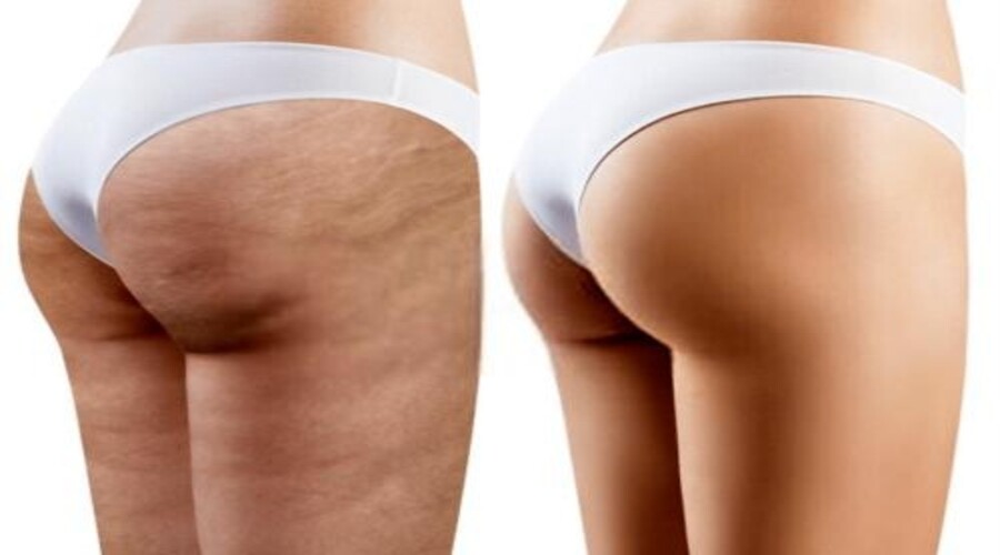 Cellulite sur les fesses : comment s'en débarrasser ?