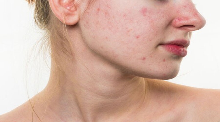 L'acné: les solutions miracles !