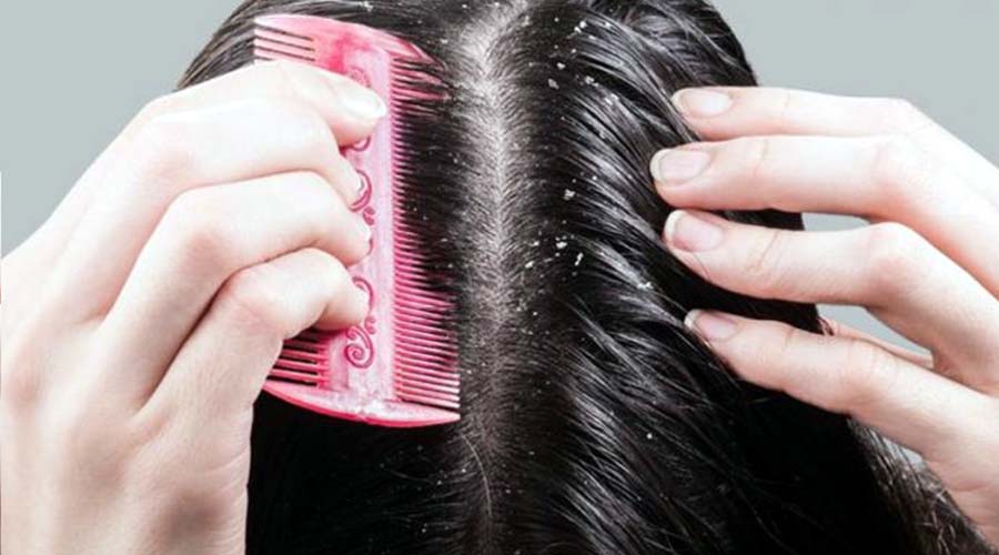 أربعة نصائح للقضاء على قشرة الشعر