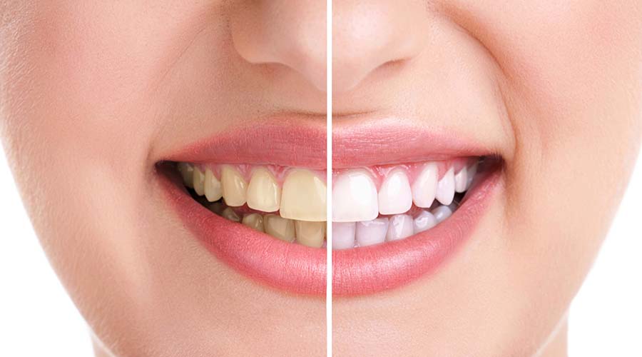 وصفات سحرية لتبييض الاسنان